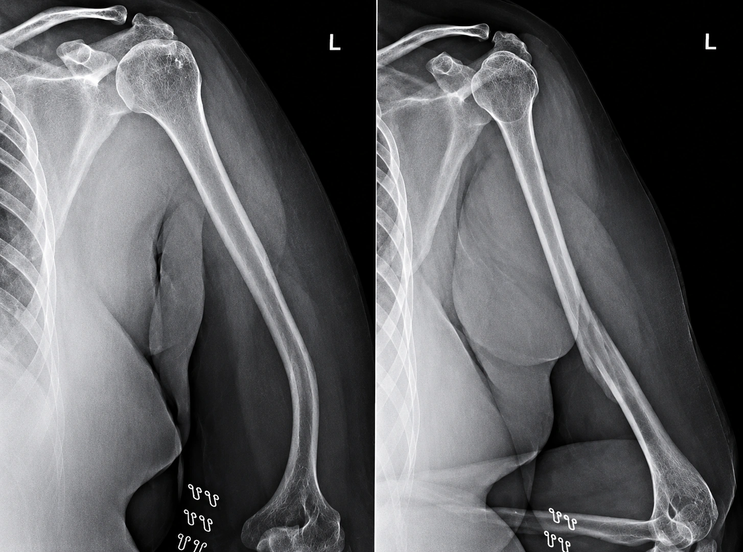 Complex Fracture Before Surgery
